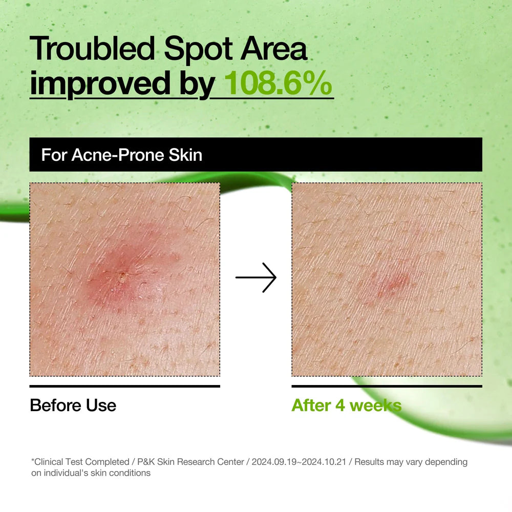 ANUA AZELAIC ACID 10 HYALURON REDNESS SOOTHING SERUM 30ML
